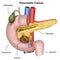 Pancreatic cancer medical  illustration