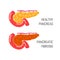 Pancreatic fibrosis concept. Vector illustration