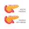 Pancreatic fibrosis concept. Vector illustration