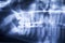 Panoramic Dental X-Ray Of Human Teeth