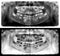 Panoramic radiograph is a scanning dental X-ray jaws of child