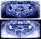 Panoramic radiograph is a scanning dental X-ray jaws of child