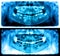 Panoramic radiograph is a scanning dental X-ray jaws of child