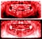 Panoramic radiograph is a scanning dental X-ray jaws of child