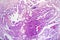 Papillary thyroid cancer, light micrograph