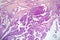 Papillary thyroid cancer, light micrograph