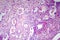 Papillary thyroid cancer, light micrograph