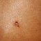 Papilloma birthmark on the skin. Treatment papillomy acid.