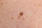 Papilloma on human skin - benign tumor in the form of mole, nevus Papillomatosis medicine