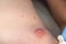 Papilloma on man& x27;s body near the nipple before laser removing, closeup view.