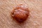 Papilloma mole on human skin macro shot, concept of health, skin care and cancer risk