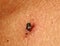 Papiloma birthmark on the skin. Treatment papilomy acid.