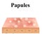 Papules. Acne on the skin. Dermatological and cosmetic diseases on the skin of the face acne. Infographics. Vector