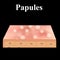 Papules. Acne on the skin. Dermatological and cosmetic diseases on the skin of the face acne. Infographics. Vector