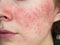 Papulopustular rosacea, the patient`s cheek