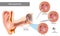 Paracentesis or myringotomy. Incision into tympanic membrane. Surgical procedure involving puncture of the tympanic