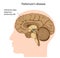 Parkinson\'s disease