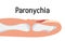 Paronychia concepnt vector for medical blog, app, banner. Nail inflammation that may result from trauma, irritation or