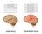 Partial and generalized epilepsy