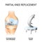 Partial knee replacement.