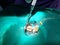The partial pulpotomy or root canal treatment in child`s molar t