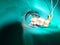 The partial pulpotomy or root canal treatment in child`s molar t