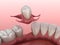 Partial removable immediate-denture type Butterfly. Replacement of one missing tooth 3D illustration