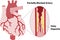 Partially Blocked Coronary Artery