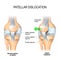 Patellar dislocation