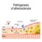 Pathogenesis of atherosclerosis