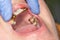 Patient with bad metal dental crowns close-up. The concept of treatment and restoration of aesthetics in the dental clinic