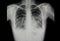 a patient with both lungs pneumonia