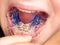 Patient photo of teeth with orthodontic braces