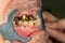 Patient`s bad teeth at the dentist`s dentist close-up macro. Caries, plaque harm smoking