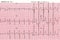 Patient`s heart wave chart, which is a tool to help physicians analyze data in hospitals.