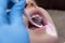 A pediatric dentist examines the baby`s baby teeth and oral cavity, close-up, selective focus.