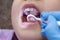 A pediatric dentist examines the baby`s baby teeth and oral cavity, close-up, selective focus.
