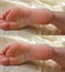 Pedicure. Cracks and dry callus on the heels. Sloppy and groomed legs. Lack of vitamins. Skin diseases feet. Before and after
