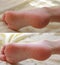 Pedicure. Cracks and dry callus on the heels. Sloppy and groomed legs. Lack of vitamins. Skin diseases feet. Before and after