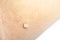 Pedunculated Mass skin tag or acrochondon or soft fibroma.