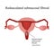 Pedunculated submucous uterine fibroids. Vaginal fibroids. Infographics. Vector illustration on background