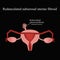 Pedunculated subserous uterine fibroids. Infographics. Vector illustration