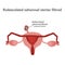 Pedunculated subserous uterine fibroids. Infographics. Vector illustration on background