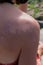 Peeling skin back and shoulder from dangerous sunburn effect on woman body from sunbath in summer