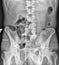 Pelvic bone, Hip Joint Medical Xray