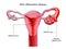 Pelvic inflammatory disease illustration