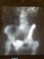 Pelvic nuclear medicine bone scan - normal image