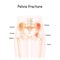 Pelvis Fracture. Vector illustration isolated on a white background