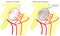 Pelvis and Hip joint problem_Avascular necrosis of the femoral h