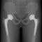 Pelvis and Hip joint problem_Bilateral hip replacement